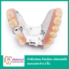 ทำฟันปลอม โครงโลหะ ชนิดถอดได้ แผงบนและล่าง 2 ชิ้น