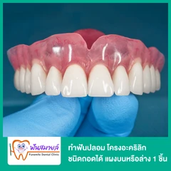 ทำฟันปลอม โครงอะคริลิก ชนิดถอดได้ แผงบนหรือล่าง 1 ชิ้น
