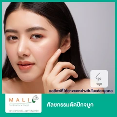 ศัลยกรรมตัดปีกจมูก 1 ครั้ง