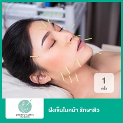 ฝังเข็มใบหน้า รักษาสิว 1 ครั้ง