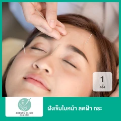 ฝังเข็มใบหน้า ลดฝ้า กระ 1 ครั้ง