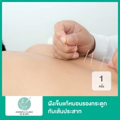 ฝังเข็มแก้หมอนรองกระดูกทับเส้นประสาท 1 ครั้ง