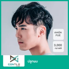 ปลูกผม ด้วยเทคนิค FUE 3,000 กราฟต์