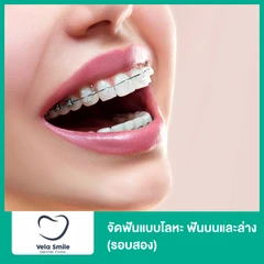 จัดฟันแบบโลหะ ฟันบนและล่าง (รอบสอง)