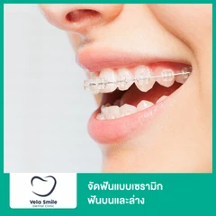 จัดฟันแบบเซรามิก ฟันบนและล่าง