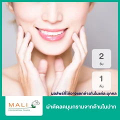 ผ่าตัดลดมุมกรามจากด้านในปาก นอนพักที่ รพ. 2 วัน 1 คืน