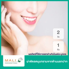 ผ่าตัดลดมุมกรามจากด้านนอกปาก นอนพักที่ รพ. 2 วัน 1 คืน