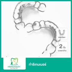 ทำรีเทนเนอร์แบบโลหะ 2 ชิ้น ฟันบนและล่าง