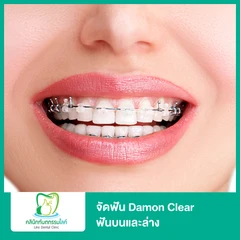 จัดฟัน Damon Clear ฟันบนและล่าง