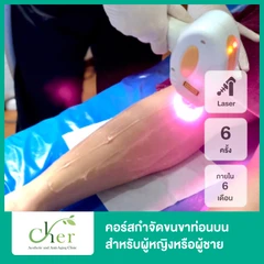 คอร์สกำจัดขนขาท่อนบน ด้วย Diode Laser 6 ครั้ง ภายใน 6 เดือน สำหรับผู้หญิงหรือผู้ชาย