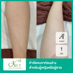 กำจัดขนขาท่อนล่าง ด้วย Diode Laser 1 ครั้ง สำหรับผู้หญิงหรือผู้ชาย