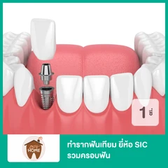 ทำรากฟันเทียม ยี่ห้อ SIC รวมครอบฟัน สำหรับฟัน 1 ซี่