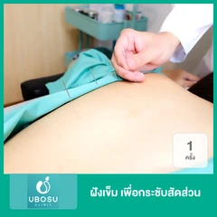 ฝังเข็ม เพื่อกระชับสัดส่วน 1 ครั้ง