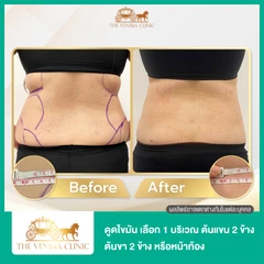 โปรแกรมดูดไขมัน ด้วยเครื่อง Body Jet Evo เลือก 1 บริเวณ ต้นแขน 2 ข้าง ต้นขา 2 ข้าง หน้าท้อง 1 ครั้ง