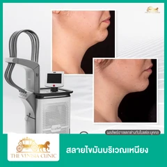 โปรแกรมสลายไขมันบริเวณเหนียง ด้วยเครื่อง SculpSure 1 ครั้ง
