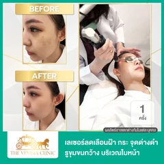 เลเซอร์ PicoSure ลดเลือนฝ้า กระ จุดด่างดำ รูขุมขนกว้าง บริเวณใบหน้า 1 ครั้ง