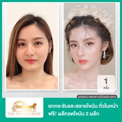 ยกกระชับและสลายไขมัน ด้วย Smart ND Laser บริเวณทั่วใบหน้า 1 ครั้ง ฟรี! ผลึกลดไขมัน 2 ผลึก