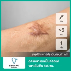 ฉีดรักษาแผลเป็นคีลอยด์ ขนาดเส้นผ่านศูนย์กลางไม่เกิน 5x5 ซม. 5 จุดขึ้นไป 1 ครั้ง