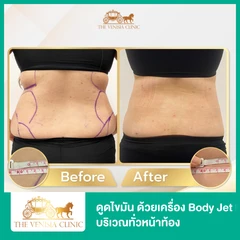 โปรแกรมดูดไขมัน ด้วยเครื่อง Body Jet Evo บริเวณทั่วหน้าท้อง 1 ครั้ง
