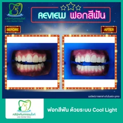 ฟอกสีฟัน ด้วยระบบ Cool Light