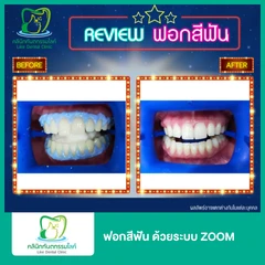 ฟอกสีฟัน ด้วยระบบ Zoom