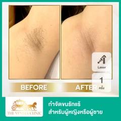 เลเซอร์ Diolaze XL กำจัดขนรักแร้ 1 ครั้ง