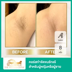 คอร์สเลเซอร์ Mediostar กำจัดขนรักแร้ 8 ครั้ง