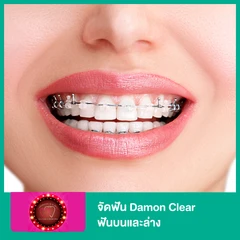 จัดฟัน Damon Clear ฟันบนและล่าง