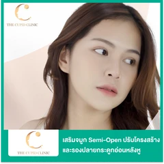 เสริมจมูก ด้วยซิลิโคนเกาหลี Misti เทคนิค Semi-Open พร้อมปรับโครงสร้างจมูก และรองปลายกระดูกอ่อนหลังหู + เนื้อเยื่อหลังหู สำหรับเคสทำครั้งแรกหรือเคสแก้