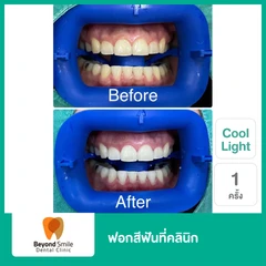 ฟอกสีฟันที่คลินิก ด้วยระบบ Cool Light 1 ครั้ง