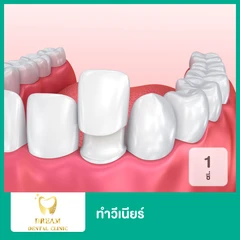 ทำวีเนียร์ EMax หรือ Zirconia IPS Empress The Ultimate in Metal-Free-Esthetics 1 ซี่
