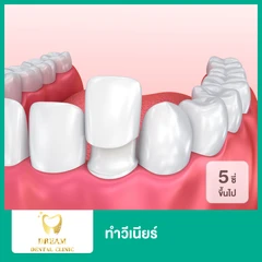 ทำวีเนียร์ EMax หรือ Zirconia IPS Empress The Ultimate in Metal-Free-Esthetics 5 ซี่ขึ้นไป (ราคาต่อ 1 ซี่)