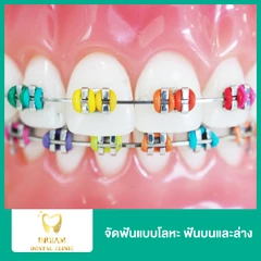 จัดฟันแบบโลหะ ฟันบนและล่าง