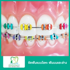 จัดฟันแบบโลหะ ฟันบนและล่าง