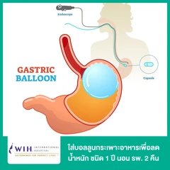 ใส่บอลลูนกระเพาะอาหารเพื่อลดน้ำหนัก (Gastric Balloon) ชนิด 6 เดือน นอน รพ. 1 คืน