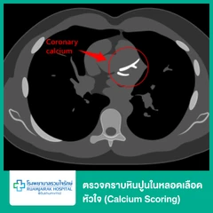 ตรวจคราบหินปูนในหลอดเลือดหัวใจ (Calcium Scoring)