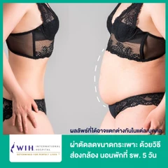 ผ่าตัดลดขนาดกระเพาะ ด้วยวิธีส่องกล้อง นอนพักที่ รพ. 5 วัน