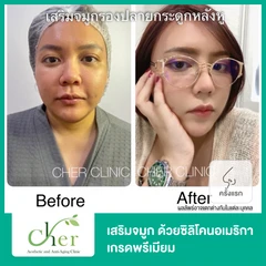 เสริมจมูก ด้วยซิลิโคนอเมริกาเกรดพรีเมียม สำหรับเคสทำครั้งแรก