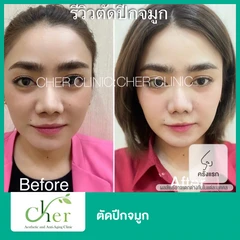 ตัดปีกจมูก สำหรับเคสทำครั้งแรก