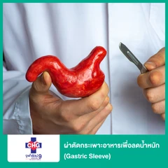 ผ่าตัดกระเพาะอาหารเพื่อลดน้ำหนัก (Gastric Sleeve)