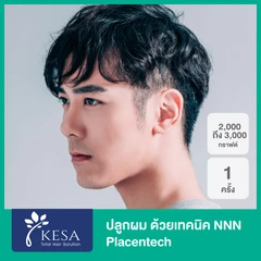 ปลูกผม ด้วยเทคนิค NNN 2025 Placentech จำนวน 2,001-3,000 กราฟต์ 1 ครั้ง