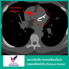 ตรวจวัดปริมาณแคลเซียมที่ผนังหลอดเลือดหัวใจ (Calcium Score)