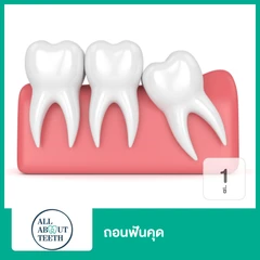 ถอนฟันคุด 1 ซี่