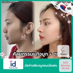 มัดจำเสริมจมูกแบบโอเพ่น 3 Steps สำหรับเคสทำครั้งแรก