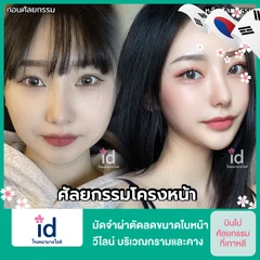 มัดจำผ่าตัดลดขนาดใบหน้า วีไลน์ บริเวณกรามและคาง สำหรับเคสทำครั้งแรก
