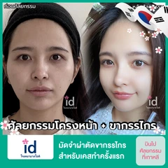 มัดจำผ่าตัดขากรรไกร สำหรับเคสทำครั้งแรก