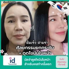 มัดจำดูดไขมันใบหน้า สำหรับเคสทำครั้งแรก