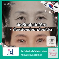 มัดจำจัดเรียงไขมันใต้ตา พร้อมตัดหนังหย่อนคล้อยใต้ตา สำหรับเคสทำครั้งแรก