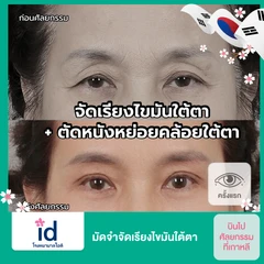 มัดจำผ่าตัดเรียงไขมันใต้ตา สำหรับเคสทำครั้งแรก