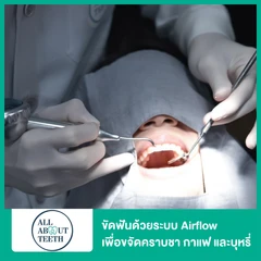 ขัดฟันด้วยระบบ Airflow เพื่อขจัดคราบชา กาแฟ และบุหรี่